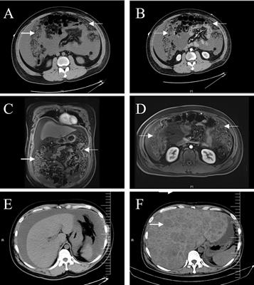 Malignant rhabdoid tumor of the omentum in an adult male: a case report and literature review